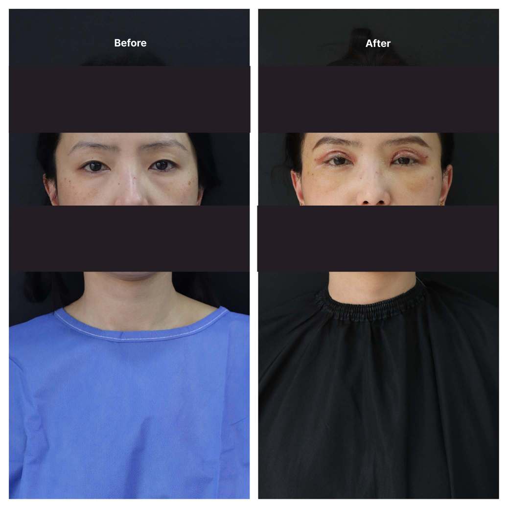 Eyelid Surgery KOQ10